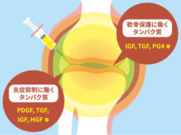 炎症抑制と軟⾻保護作⽤を⾼めたACP PRP療法
