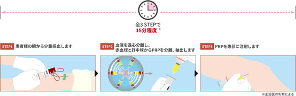 ACP PRP療法の治療のステップ